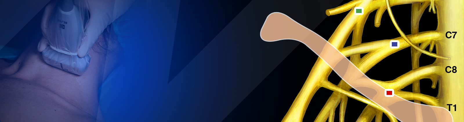 CME COURSE – Upper Extremity Blocks Part I